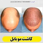 کاشت مو بابل، کاشت موی بابل، کلینیک کاشت مو بابل، کلینیک تخصصی کاشت مو بابل، متخصص کاشت مو بابل، دکتر کاشت مو بابل، قیمت کاشت مو بابل، هزینه کاشت مو بابل، الو سلام بابل، الو سلام مشاغل، سایت مشاغل بابل، سایت مشاغل استان مازندران، سایت ثبت مشاغل ایران، بازاریاب اینترنتی مشاغل ایران، سایت ثبت شغل در گوکل، الو سلام