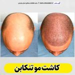 کاشت مو تنکابن، کاشت موی تنکابن، کلینیک کاشت مو تنکابن، کلینیک تخصصی کاشت مو تنکابن، مرکز کاشت مو تنکابن، متخصص کاشت مو تنکابن، دکتر کاشت مو تنکابن، قیمت کاشت مو تنکابن، هزینه کاشت مو تنکابن، الو سلام تنکابن، الو سلام مشاغل، سایت مشاغل تنکابن، سایت مشاغل مازندران