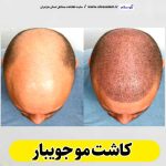 کاشت مو جویبار، کاشت موی جویبار، کاشت مو طبیعی جویبار، کلینیک کاشت مو جویبار، کلینیک تخصصی کاشت مو جویبار، مرکز کاشت مو جویبار، متخصص کاشت مو جویبار، دکتر کاشت مو جویبار، قیمت کاشت مو جویبار، هزینه کاشت مو جویبار، الو سلام جویبار، الو سلام مشاغل، سایت مشاغل جویبار، سایت مشاغل مازندران