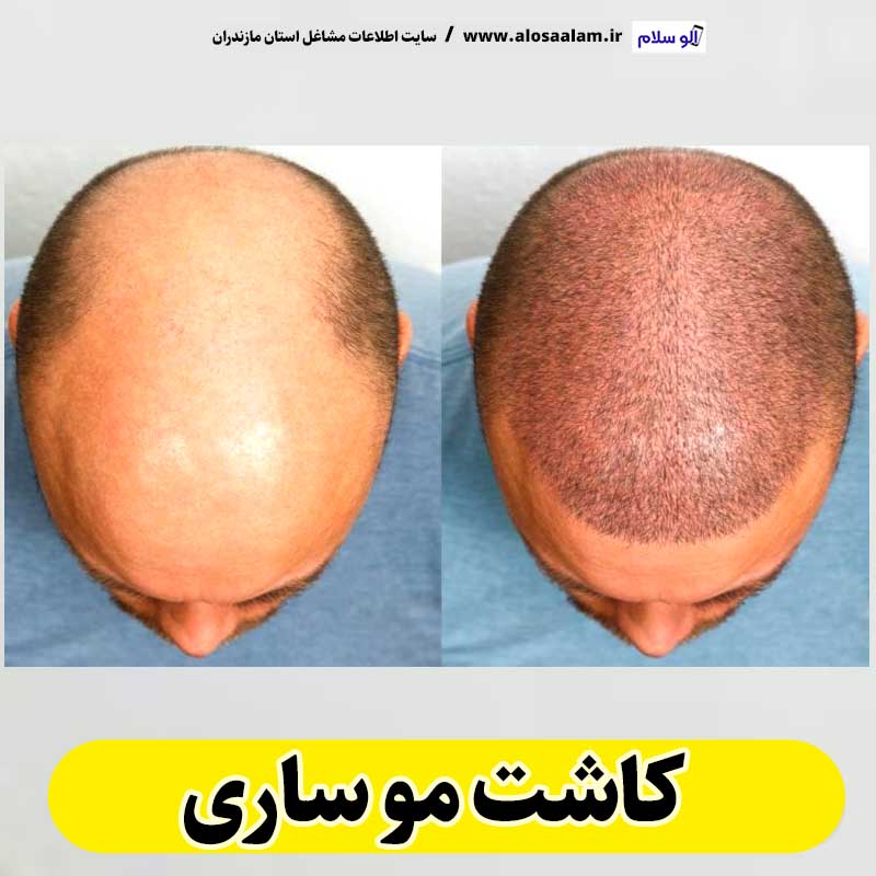 کاشت مو ساری، کاشت موی ساری، کلینیک کاشت مو ساری، کلینیک تخصصی کاشت مو ساری، مرکز کاشت مو ساری، متخصص کاشت مو ساری، دکتر کاشت مو ساری، قیمت کاشت مو ساری، هزینه کاشت مو ساری، الو سلام ساری، الو سلام مشاغل، سایت مشاغل ساری، سایت مشاغل مازندران