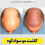 کاشت مو سوادکوه، کاشت موی سوادکوه، کاشت مو طبیعی سوادکوه، کلینیک کاشت مو سوادکوه، کلینیک تخصصی کاشت مو سوادکوه، مرکز کاشت مو سوادکوه، متخصص کاشت مو سوادکوه، دکتر کاشت مو سوادکوه، قیمت کاشت مو سوادکوه، هزینه کاشت مو سوادکوه، الو سلام سوادکوه، الو سلام مشاغل، سایت مشاغل سوادکوه، سایت مشاغل مازندران