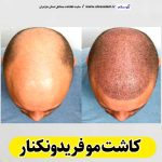 کاشت مو فریدونکنار، کاشت موی فریدونکنار، کاشت مو طبیعی فریدونکنار، کلینیک کاشت مو فریدونکنار، کلینیک تخصصی کاشت مو فریدونکنار، مرکز کاشت مو فریدونکنار، متخصص کاشت مو فریدونکنار، دکتر کاشت مو فریدونکنار، قیمت کاشت مو فریدونکنار، هزینه کاشت مو فریدونکنار، الو سلام فریدونکنار، الو سلام مشاغل، سایت مشاغل فریدونکنار، سایت مشاغل مازندران