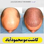 کاشت مو محمودآباد، کاشت موی محمودآباد، کاشت مو طبیعی محمودآباد، کلینیک کاشت مو محمودآباد، کلینیک تخصصی کاشت مو محمودآباد، مرکز کاشت مو محمودآباد، متخصص کاشت مو محمودآباد، دکتر کاشت مو محمودآباد، قیمت کاشت مو محمودآباد، هزینه کاشت مو محمودآباد، الو سلام محمودآباد، الو سلام مشاغل، سایت مشاغل محمودآباد، سایت مشاغل مازندران