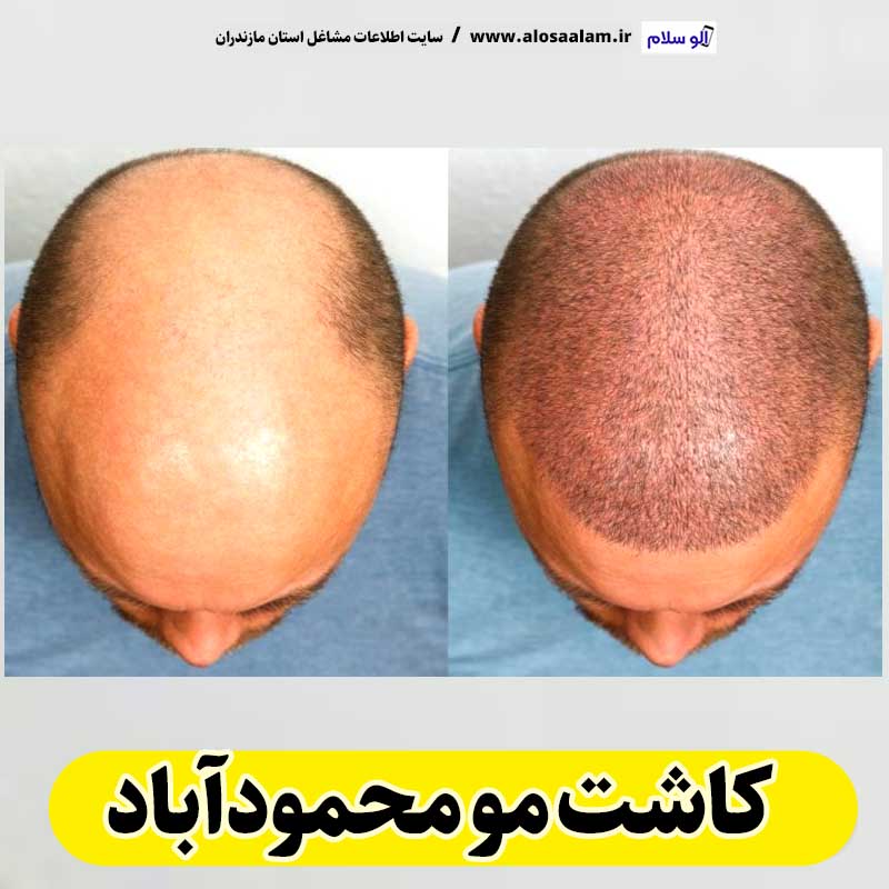 کاشت مو محمودآباد، کاشت موی محمودآباد، کاشت مو طبیعی محمودآباد، کلینیک کاشت مو محمودآباد، کلینیک تخصصی کاشت مو محمودآباد، مرکز کاشت مو محمودآباد، متخصص کاشت مو محمودآباد، دکتر کاشت مو محمودآباد، قیمت کاشت مو محمودآباد، هزینه کاشت مو محمودآباد، الو سلام محمودآباد، الو سلام مشاغل، سایت مشاغل محمودآباد، سایت مشاغل مازندران