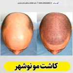 کاشت مو نوشهر، کاشت موی نوشهر، کلینیک کاشت مو نوشهر، کلینیک تخصصی کاشت مو نوشهر، مرکز کاشت مو نوشهر، متخصص کاشت مو نوشهر، دکتر کاشت مو نوشهر، قیمت کاشت مو نوشهر، هزینه کاشت مو نوشهر، الو سلام نوشهر، الو سلام مشاغل، سایت مشاغل نوشهر، سایت مشاغل مازندران