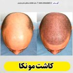 کاشت مو نکا، کاشت موی نکا، کاشت مو طبیعی نکا، کلینیک کاشت مو نکا، کلینیک تخصصی کاشت مو نکا، مرکز کاشت مو نکا، متخصص کاشت مو نکا، دکتر کاشت مو نکا، قیمت کاشت مو نکا، هزینه کاشت مو نکا، الو سلام نکا، الو سلام مشاغل، سایت مشاغل نکا، سایت مشاغل مازندران