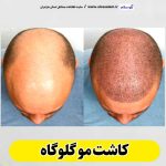 کاشت مو گلوگاه، کاشت موی گلوگاه، کاشت مو طبیعی گلوگاه، کلینیک کاشت مو گلوگاه، کلینیک تخصصی کاشت مو گلوگاه، مرکز کاشت مو گلوگاه، متخصص کاشت مو گلوگاه، دکتر کاشت مو گلوگاه، قیمت کاشت مو گلوگاه، هزینه کاشت مو گلوگاه، الو سلام گلوگاه، الو سلام مشاغل، سایت مشاغل گلوگاه، سایت مشاغل مازندران
