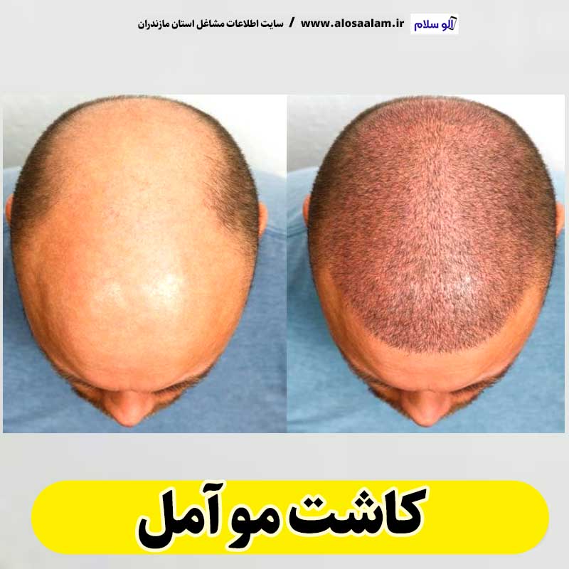 کاشت مو آمل، کاشت موی آمل، کلینیک کاشت مو آمل، کلینیک تخصصی کاشت مو آمل، متخصص کاشت مو آمل، دکتر کاشت مو آمل، قیمت کاشت مو آمل، هزینه کاشت مو آمل، الو سلام آمل، الو سلام مشاغل، سایت مشاغل آمل، سایت مشاغل مازندران