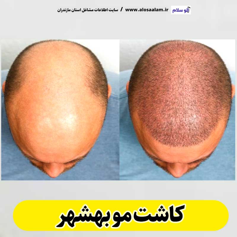 کاشت مو بهشهر، کاشت موی بهشهر، کلینیک کاشت مو بهشهر، کلینیک تخصصی کاشت مو بهشهر، مرکز کاشت مو بهشهر، متخصص کاشت مو بهشهر، دکتر کاشت مو بهشهر، قیمت کاشت مو بهشهر، هزینه کاشت مو بهشهر، الو سلام بهشهر، الو سلام مشاغل، سایت مشاغل بهشهر، سایت مشاغل مازندران