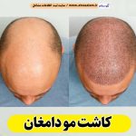 کاشت مو دامغان، کاشت موی دامغان، کلینیک کاشت مو دامغان، کلینیک تخصصی کاشت مو دامغان، مرکز کاشت مو دامغان، متخصص کاشت مو دامغان، دکتر کاشت مو دامغان، قیمت کاشت مو دامغان، هزینه کاشت مو دامغان، الو سلام دامغان، الو سلام مشاغل، سایت مشاغل دامغان، سایت ثبت مشاغل، الو سلام