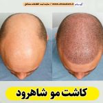 کاشت مو شاهرود، کاشت موی شاهرود، کلینیک کاشت مو شاهرود، کلینیک تخصصی کاشت مو شاهرود، مرکز کاشت مو شاهرود، متخصص کاشت مو شاهرود، دکتر کاشت مو شاهرود، قیمت کاشت مو شاهرود، هزینه کاشت مو شاهرود، الو سلام شاهرود، الو سلام مشاغل، سایت مشاغل شاهرود، سایت ثبت مشاغل، الو سلام
